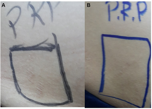 Figure 5 (A) Striae on the back before treatment, (B) improvement of striae after 3 sessions of PRP.