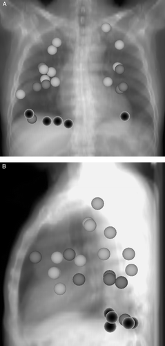 Figure 1.  Position and mobility of all 25 treated lesions (Figure 1A frontal view, Figure 1B lateral view). The size of the treated lesions is not considered in this figure. Light grey: movement < 5 mm; dark grey: movement 5 mm to 10 mm; black: movement > 10 mm.