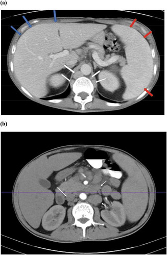 Figure 2. (a) Abdomen and pelvis CT scan: The liver is large measuring up to 24 cm (blue arrows). The spleen is large measuring 17.4 cm (red arrows), retrocrural lymphadenopathy (white arrows). (b) Abdomen and pelvis CT scan: Retroperitoneal lymph nodes (white arrows).