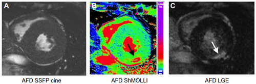 Figure 4 Anderson-Fabry disease.