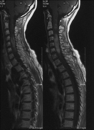 Figure 2.  MRI cervical spine showed contrast enhancing cervical intramedullary lesion with cord expansion.