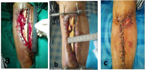 Figure 5 The wound image of typical case 1. (a) preoperation, (b) postoperative day 4, (c) postoperative day 15. The length, width and depth of the wound are 15.5 cm, 7.8 cm and 1.5 cm, respectively. The area is 120.9 cm2.