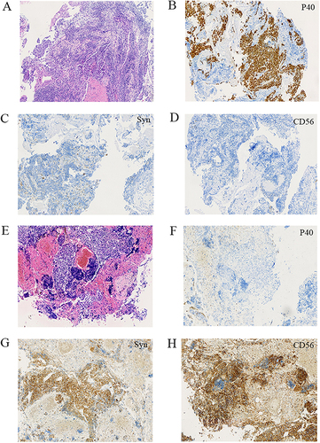 Figure 2 (A) Microscopic appearances of the pulmonary tumor showed lung SCC (HE staining x100). (B–D) Immunohistochemical staining for P40(+), Syn (-) and CD56(-), which are the optimal immunohistochemical markers for SCC (HE staining x100). (E) Microscopic appearances showed transformed SCLC (HE staining x100). (F–H) Immunohistochemical staining for P40(-), Syn (+) and CD56(+), which are the optimal immunohistochemical markers for transformed SCLC (HE staining x100).