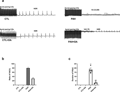 Figure 3. Effects of Dapagliflozin on the vulnerability of ventricular arrhythmia in PAH’s rats. Representative images of burst pacing (a). Ratio of VA induced by burst pacing (b). Duration of VA in rats (c) (n = 8–10 each group). Data are presented as mean as ±SEM. *P < 0.05 vs. CTL group, #P < 0.05 vs. PAH group. **P < 0.01 vs. CTL group, ##P < 0.01 vs. PAH group. Abbreviations: NSR, normal sinus rhythm; VA, ventricular arrhythmia.