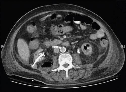 Figure 1. CT scan showing right posterior pararenal space gas-containing abscess and left emphysematous pyelonephritis.