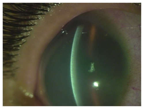 Figure 1 Preoperative appearance of right eye of patient. Best corrected visual acuity counting fingers at 1 m.