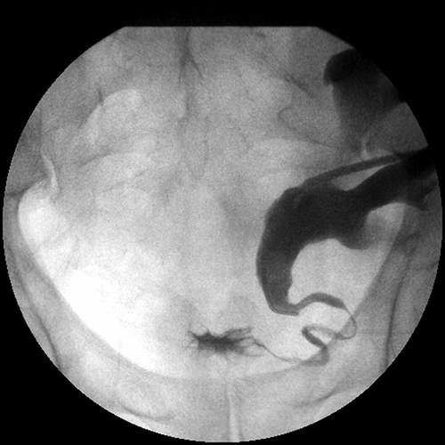 Figure 1. Anterograde pyelography demonstrates stricture involving the mid- and distal ureter.