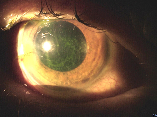 Figure 3 Slit lamp photograph of the patient’s right eye on the first post-operative day after combined cataract surgery and ab interno goniotomy with the Kahook Dual Blade. Significant ocular surface dryness is seen upon fluorescein staining.