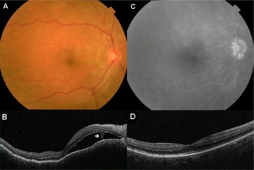 Figure 2 Serous retinal detachments due to sympathetic ophthalmia in the right eye.Notes: (A) Fundus photograph of the right eye showing serous retinal detachments in the posterior pole. (B) OCT of the right eye showing serous retinal detachment. An arrow indicates subretinal septum, which is the characteristic of sympathetic ophthalmia. (C) Late-phase fluorescein angiography shows a broad area of hyperfluorescence in the posterior pole and optic disc. (D) OCT of the right eye after a cycle of pulse steroid therapy and oral prednisolone administration showing disappearance of serous retinal detachment.