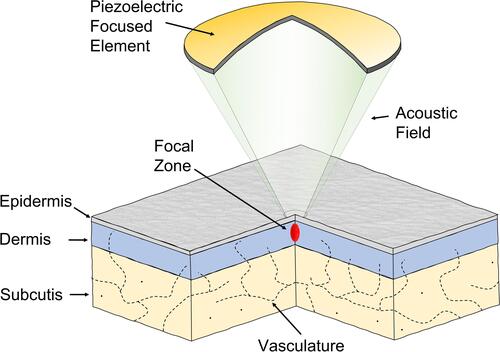 Figure 1 High-frequency HIFU applied to the human skin.Citation13 At 20 MHz, the focal zone is sufficiently small to prevent damages to the deeper part of the dermis and subcutaneous layer below.