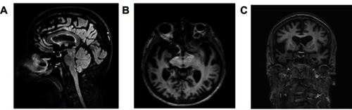 Figure 1 Neuroimaging examinations. The patient’s first MRI brain scan (3 tesla), performed about 2 years into his illness. Panel A: Sagittal FLAIR T2 image highlights the marked frontal and cingulate atrophy. Panel B: The axial 3D FFE T1-w image shows bilateral anterior temporal lobe atrophy (right > left). Panel C: Coronal FFE 3D T1-w image shows fronto-insular and anterior temporal cortical atrophy, mainly on the right side.