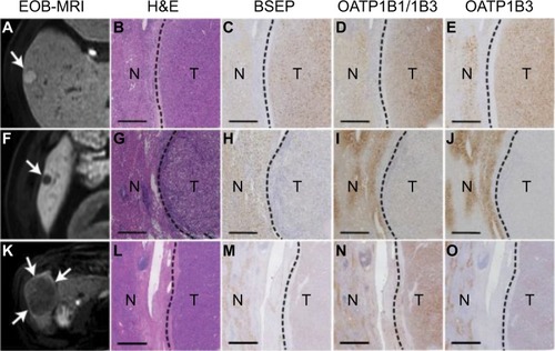 Figure 8 Relationship between expression of different genes and the tumor enhancement patterns in hepatobiliary phase images of EOB-MRI.Citation44