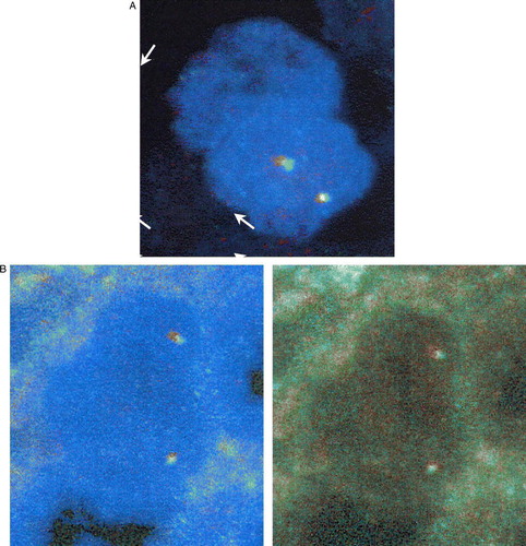 Figure 1.  FISH analysis with RET-specific DNA probes on paraffin sections. A. Status of the proto-oncogene RET in an ER/PR-positive tissue control: A normal cell exhibiting overlapping FISH signals. B. Status of the proto-oncogene RET in the papillary thyroid cancer sample exhibiting overlapping FISH signals (no split-aparts)