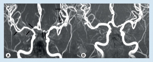 Figure 1. Characteristic angiographic findings of reversible cerebral vasoconstriction syndrome.(A) Multi-focal segmental vasoconstrictions and (B) their normalization in a patient with reversible cerebral vasoconstriction syndrome (vasoconstrictions are indicated by black arrows).