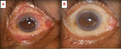 Figure 5 (A) Clinical photograph of a giant ocular surface squamous neoplasia (about 250°) in the right eye. (B) Clinical photograph after four cycles of topical 5FU drops.