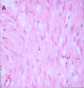 FIG. 1 (A) H & E section of GIST showing classic spindle-cell morphology. (B) H & E section of same tumor from area of rhabdoid differentiation with dense eosinophilic cytoplasm and eccentric nuclei.