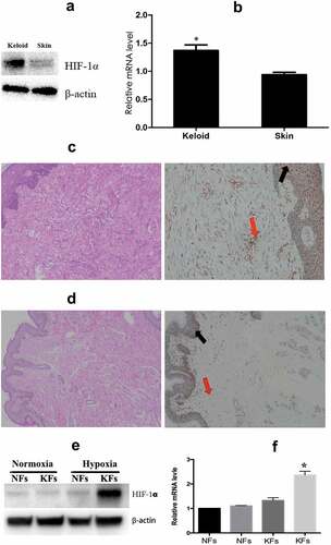 Figure 1. Keloid tissues expressed a higher level of HIF-1α than normal skin tissues. The expression of HIF-1α at both the protein (a) and mRNA (b) level was significantly higher in the keloid tissues than in normal skin tissues. Immunohistochemical staining of HIF-1α in keloid tissues (c) and normal skin tissues (d) for analysis of the expression and localization of HIF-1α. The transcription and protein levels of HIF-1α were also significantly higher in KFs (e, left) than those in NFs (f). Additionally, the level of HIF-1α protein in KFs was further increased under hypoxia (1e, right). (*p < 0.05)