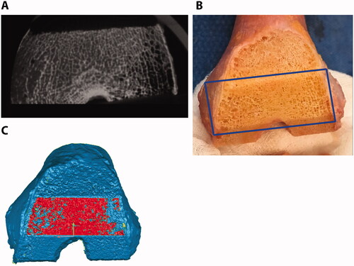 Figure 3. Micro-CT (A), gross photography (B), and laser scan (C) show the same femoral anterior chamfer cut surface for one representative specimen. Dark regions in the micro-CT are porous regions that are not densely occupied by trabeculae. An appropriate crease angle was used to select the cut bone surface (red) in the laser scan without significant trabecular porosity.