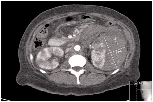 Figure 3. CT image of the left kidney showing perirenal hematoma.