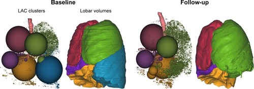 Figure 1 Calculation of the TLVR based on thin-section MDCT scan analysis using quantitative imaging software (Apollo; VIDA Diagnostics, Coralville, IA, USA).