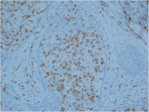 Figure 5 T cells were the predominantly infiltrated cells in CL, T cell receptor marker CD3. (Magnification ×200).