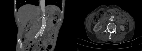 Figure 4 Eight months after the procedure and with continuous regular anti-infective treatment. The bubbles and liquid dark areas around the abdominal aorta had disappeared.