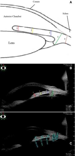 Figure 1 Ultrasound biomicroscopy (UBM). (A) shows a scheme and (B) shows a real Image of the iris and the ciliary body depicting where thickness measurements of the iris [iris thicknesses at 0.8 mm from the iris root (1, blue line), midway along the radial length of the iris (2, yellow line), and at the juxtapupillary margin (3, red line)], and the ciliary body [ciliary body (4, blue line), and ciliary body with ciliary processes (5, green line)] were obtained. (C) Real measurements for one of the patients were the iris thicknesses at 0.8 mm from the iris root was 0.42mm, at midway along the radial length of the iris was 0.52mm, and at the juxtapupillary margin was 0.7mm. The ciliary body thickness was 0.72 mm and the ciliary body with ciliary processes thickness was 1.38mm.