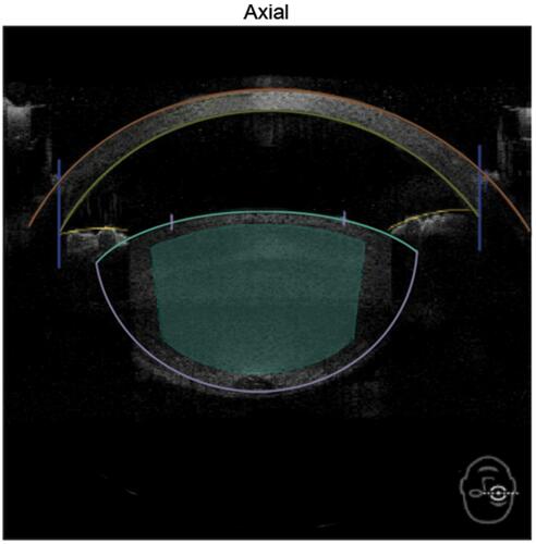 Figure 3 Anterior-segment axial scan by spectral-domain OCT of Catalys precision-laser system. Dense cataracts were noticed to extend posteriorly beyond the minimum laser-fragmentation offset of 500 μm from the posterior capsule.