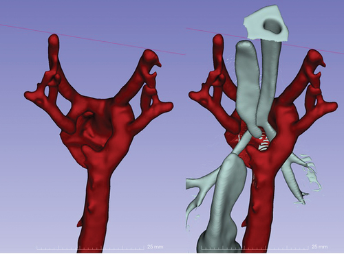 Figure 1. Doble aprtic Arch: CTA with three-dimensional reconstruction of the vascular ring that encircles the trachea and esophagus.