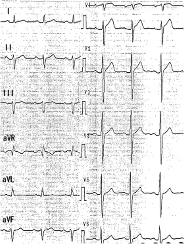 Figure 2 Previous electrocardiography taken during daily cibenzoline alone.