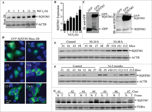 Figure 1. Upregulation of SQSTM1 expression by nickel in vitro and in vivo, as well as SQSTM1 overexpression in human lung cancer tissues. (A and B) 2×105 of Beas-2B cells were seeded into each well of 6-well plates. After the cell density reached 80∼90%, the cells were exposed to 1.0 mM NiCl2 for the various time points indicated. The cells were then extracted with an SDS-sample buffer (10 mM Tris-HCl, pH 7.4, 1% SDS, 1mM Na3VO4, and 1× complete protease inhibitor) and cell extracts were subjected to protein gel blot. ACTB was used as a control for protein loading. The data shown in (A) are representative of 3 independent experiments, and the SQSTM1 expression band was quantitatively analyzed by using prism software and presented in (B). (C) Beas-2B GFP-SQSTM1 stable transfectants were identified with western blotting; primary antibodies against GFP or SQSTM1 were used to determine exogenous GFP-SQSTM1 expression. (D) Beas-2B(GFP-SQSTM1) cells (1×104) were seeded into each well of an 8-well chamber. Following culturing at 37°C for 48 h, the cells were treated with 1.0 mM NiCl2 for the time points indicated, and the GFP-SQSTM1 distributions in Beas-2B cells were captured using fluorescence microscopy. (E-G) C57BL/6J mice were exposed to nickel nanoparticles via inhalation for 24 h or 48 h (E) or 5-months (F). Lung tissues were extracted for protein extracts and the extracts were subjected to western blot. ACTB was used as a protein loading control. (G) Seven pairs of human primary lung cancers and their adjacent normal lung tissues were obtained from the First Affiliated Hospital of Wenzhou Medical University; the tissue extracts were subjected to western blotting and TUBA was used as a protein loading control.