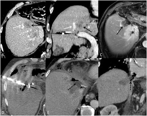 Figure 6. Patient followed for recto sigmoid adenocarcinoma with synchronous bi-lobar hepatic metastases. Ten FOLFOX cures were performed. The good response to this neoadjuvant treatment made it possible to perform liver surgery by left hepatectomy, on histological examination, two tumors compatible with a Lieberkühnien adenocarcinoma moderately differentiated and tumor regression TRG3 with complete exeresis. A few months later, appearance of two tumors of less than 2 cm in the liver treated by stereotactic radiotherapy. A few months later, recurrence on the hepatectomy slices with MTB decision to perform a percutaneous thermo-ablation. Images A and B are axial (A) and coronal (B) reconstruction scans with intravenous injection of contrast material at portal phase showing metastasis (black arrow) and vascular contact with the right suprahepatic vein (white dotted arrow) and the portal branch of segment VIII (white arrow). Image (C) is a T1-weighted axial MRI acquisition after injection of gadolinium portal phase, showing stereotactic radiotherapy sequellae as a hyper vascularization zone (black asterix). A few weeks later, an alteration in the general state appeared, with evidence of septic thrombosis of the right hepatic vein. Images E and F are scanner acquisitions after intravenous injection of contrast medium at portal phase, showing a probable abcedation of the microwave zone with the presence of a hydroaerous level (black dotted arrow) and fistulization of the right atrium. This case highlights the precautions to be taken in the treatment of CRC metastases close to large vessels by microwave on a weakened hepatic parenchyma. Indeed, the modification related to radiotherapy combined with the effect of microwaves is probably responsible for this complication.