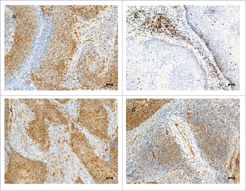 Figure 1. Representative examples of immunohistochemical expression of TAZ and YAP in cervical cancer patients. Upper panel: a tumor expressing TAZ in tumor cells, endothelial cells and non-lymphocytic stromal cells, but not in TILs (A); a tumor expressing TAZ exclusively in TILs (B). Lower panel: a tumor expressing YAP in tumor cells, endothelial cells and non-lymphocytic stromal cells, but not in TILs (C); a tumor expressing YAP in TILs, tumor cells and endothelial cells (D). Scale bar = 30 µm.