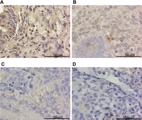 Figure 3 xCT was down-regulated in endometrial cancer specimens. Representative images of xCT immunohistochemistry staining in (A) CON, (B) SEH, (C) AEH and (D) EC specimens.