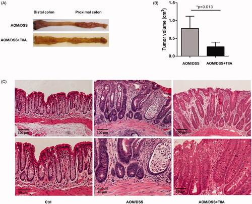 Figure 2. Inhibitory effects of tanshinone IIA on AOM/DSS-induced colorectal tumorigenesis in mice. (A) Representative luminal views of the colons from AOM/DSS-treated and AOM/DSS + tanshinone IIA-treated mice. (B) Quantification of colonic tumour volume in AOM/DSS-treated and AOM/DSS + tanshinone IIA-treated mice. Error bars represent the mean ± SD (n = 6 for each group). *p < 0.05 indicates a significant difference between mice. (C) Representative histopathological images of colon from control mice, mice treated with AOM/DSS or AOM/DSS plus tanshinone IIA. Tanshinone IIA significantly inhibited colorectal tumour formation and inflammatory cell infiltration in AOM/DSS-treated mice.