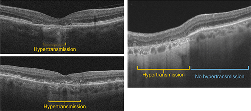 Figure 4 Advanced AMD/geographic atrophy via OCT.