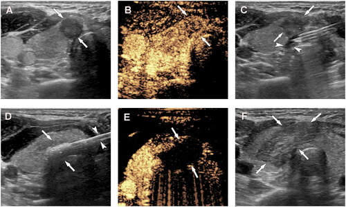 Figure 2. A 31-year-old woman with papillary thyroid cancer in the isthmus of the thyroid was treated with microwave ablation (MWA). (A) Before MWA, ultrasonography (US) showed a hypoechoic target tumor (arrows); (B) before MWA, contrast-enhanced US (CEUS) showed a hypo-enhancement pattern in the artery phase (arrows); (C) the hydrodissection technique (arrowheads) was used to protect the trachea surrounding the tumor (arrows); (D) US showed a hyperechoic pattern in the tumor (arrows) during ablation; (E), after MWA, CEUS showed no enhancement (arrows) in the tumor area; and (F) on day 1 after MWA, US showed a hypoechoic ablation zone (arrows).