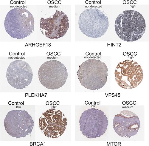 Figure 3 Immunohistochemical analysis. Expression of immune-related signature genes in normal ovarian and ovarian cancer tissues explored using the Human Protein Atlas database.