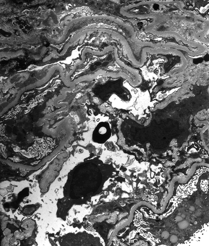 Figure 3. Electron microscopy showing electron-dense deposits in the mesangium (original magnification ×8000).