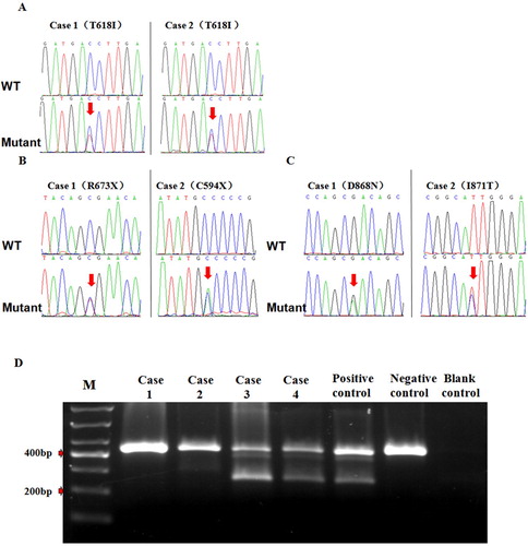 Figure 1. Mutation test results in 4 cases of patients with CNL gene. A: Sequencing results of CSF3R gene mutation in 2 patients with CNL. B: Sequencing results of ASXL1 gene mutation in 2 patients with CNL. C: Sequencing results of SETBP1 gene mutation in 2 patients with CNL. D: Analysis JAK2 V617F mutation using allele specific polymerase chain reaction. Patients (case3.and case4) strongly exhibit positive.