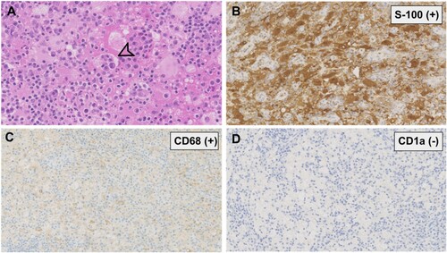 Figure 1. Histopathological and immunohistochemical findings. (A) Histiocytes in the background of plasma cells and lymphocytes, exhibiting abundant pale cytoplasm and emperipolesis (arrow). (HE. original magnification ×400); (B, C) Immunoreactive for S-100, CD68, respectively. (original magnification ×200) (D) Negative for CD1a. (original magnification ×200).