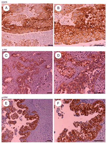 Figure 1 Representative examples of immunohistochemically stained sections positive for EGFR (A and B), pAkt (C and D) and pERK (E and F) in tumor specimens ([A, C and E], x20 original magnification; [B, D and F] x40 original magnification). Scale bars represent 100 µm.