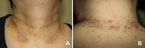 Figure 1 Clinical presentations: multiple erythematous to brownish spiny keratotic papules on the neck at the initial visit (A and B).