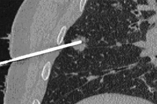 Figure 2 Computed tomography-guided biopsy of a pulmonary nodule in a 62-year-old man. Image reconstruction on a coronal oblique plane showing an 18 gauge needle with the tip inside a solid nodule of the right lung.