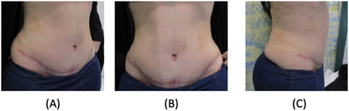 Figure 1. The reported patient at 2 weeks pregnant. Due to hormonal changes, the scar appears darker in comparison to the surrounding skin in the images. (A) Oblique view. (B) Frontal view. (C) Lateral view.