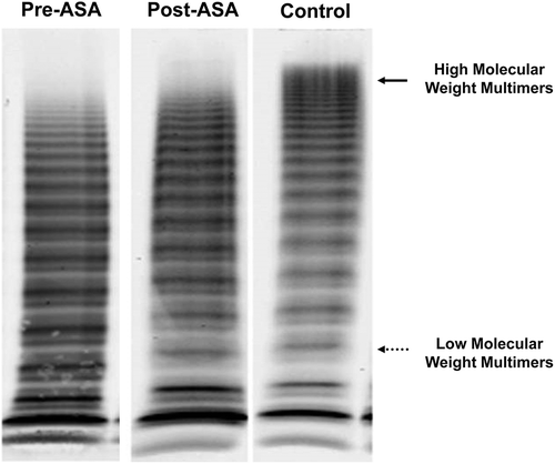 Figure 3. Von Willebrand Factor gel electrophoresis before and after alcohol septal ablation. Gel electrophoresis of VWF before (left), after (middle) with pooled plasma control (right). Loss of highest molecular weight multimers (HMWM) due to high intravascular shear is present in both patient specimens. The fraction of HMWM (normal > 10%) improved from 3–6% post-procedure. In the low molecular weight region, more dense bands indicate increased proteolysis, and this also is less post- versus pre-procedure.