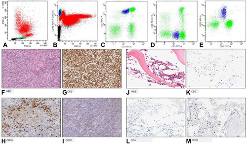 Figure 1 Case 1. Before histological diagnosis, flow cytometry analysis detected an aberrant T-cell population in peripheral blood (PB) (shown in blue). The aberrant T-cells were identified in the area of lymphocytes by using the Forward versus Side Scatter (FSC vs SSC) gating (panel A) and CD45 versus SSC (panel B) gating. These cells were positive for CD3 (dim) and CD4 (C) and negative for CD8 (D). Of note, CD10 was expressed by these cells (E). Lymph node biopsy showed typical morphological (hematoxylin and eosin, H&E) ((F); original magnification ×20) and immunohistochemical findings with positivity for CD5 ((G); original magnification ×10), CD10 ((H); original magnification ×20) and negativity for CD20 ((I); original magnification ×10). Bone marrow biopsy at diagnosis (J) showed negativity for CD3 ((K); original magnification ×20), CD4 ((L); original magnification ×20) and CD20 ((M); original magnification ×20).