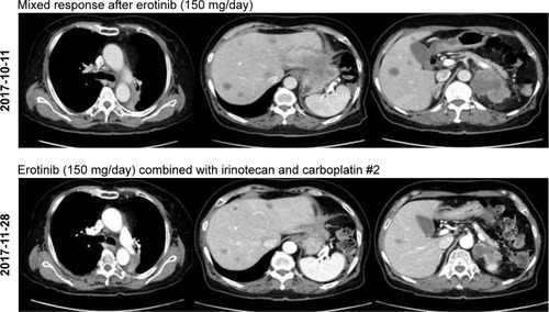 Figure 3 Computed tomography (CT) images showing differential response to single and combined therapies.