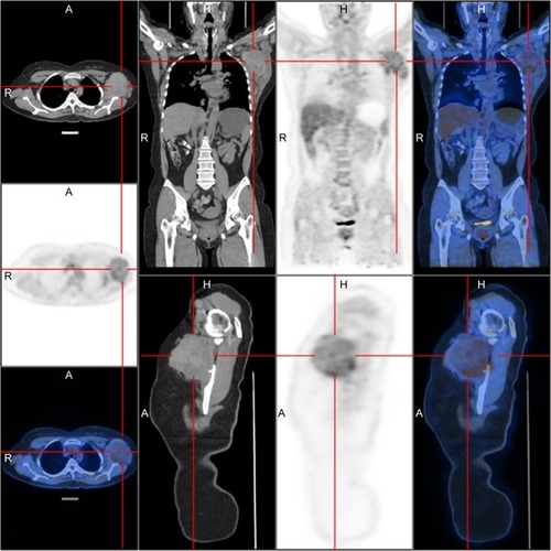 Figure 3 Imaging of 18 F-fluorodeoxyglucose (FDG) PET/CT.