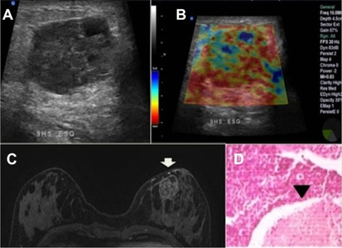 Figure 5 Heterogeneous mass in the left breast of a 45-year-old patient.